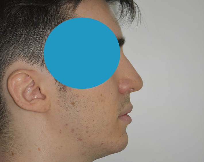 Après Profiloplastie