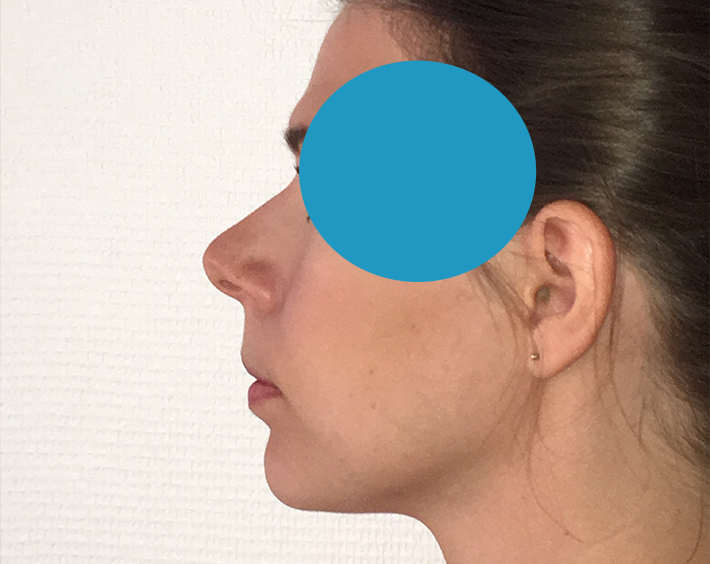 Après Profiloplastie
