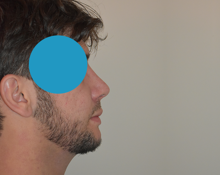 Après Profiloplastie