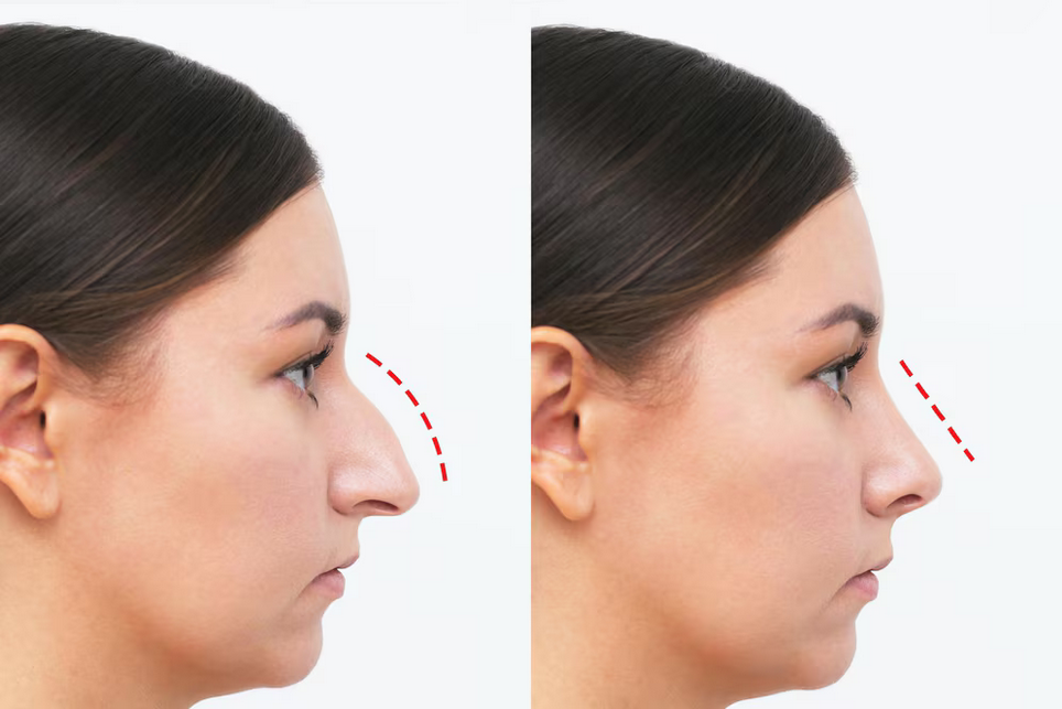 Chirurgie esthétique nez lyon