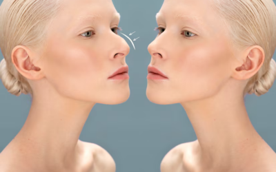 Rhinoplastie à Lyon : est-il possible de conserver une apparence naturelle sans effet « nez refait » ?