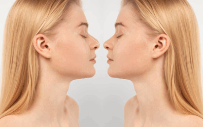 Quels types de déformations du nez peuvent être corrigés par une rhinoplastie à Lyon ?