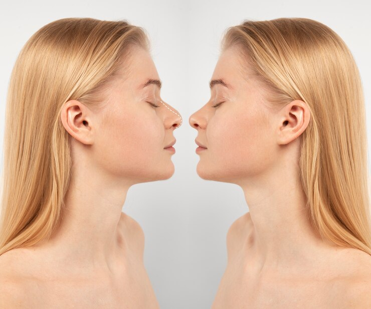 rhinoplastie à Lyon