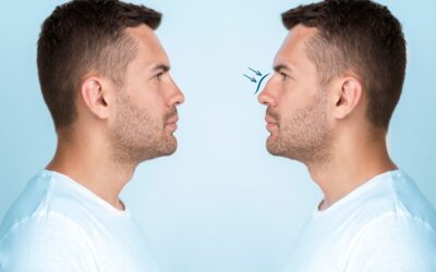 Comment les chirurgiens réalisent-ils une rhinoplastie à Lyon pour préserver la respiration ?
