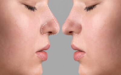 Quel est le lien entre rhinoplastie à Lyon et troubles de l’estime de soi ?
