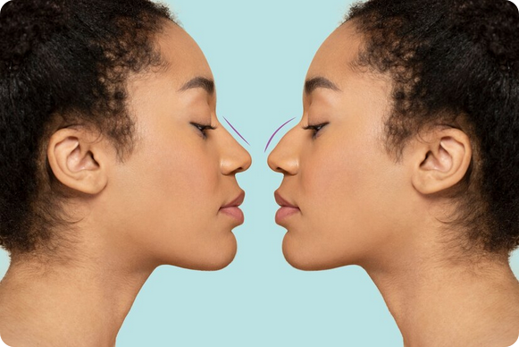 Rhinoplastie Lyon