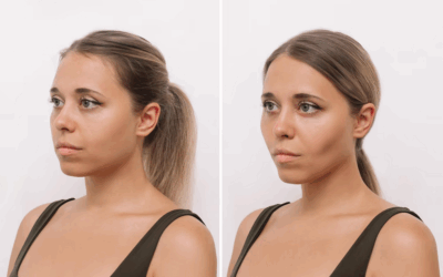 Quels résultats peut-on attendre d’une rhinoplastie avant et après à Lyon ?