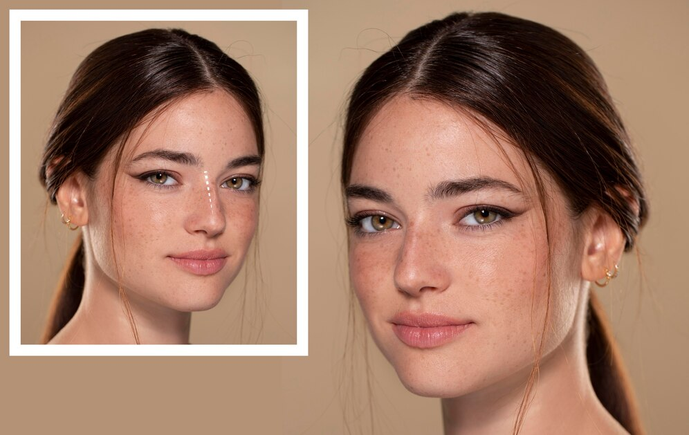 rhinoplastie à Lyon