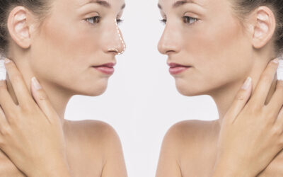 Rhinoplastie à Lyon : quels éléments peuvent limiter certaines corrections ?