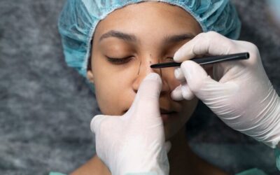 Comment la rhinoplastie à Lyon affecte-t-elle la perception de soi chez les patients ?